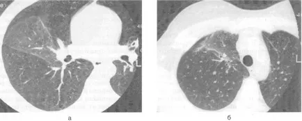 Közösségben szerzett pneumonia, CT