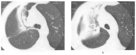 Közösségben szerzett pneumonia, CT