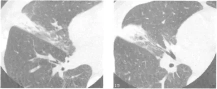 Közösségben szerzett pneumonia, CT