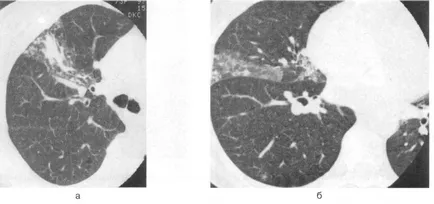 Közösségben szerzett pneumonia, CT