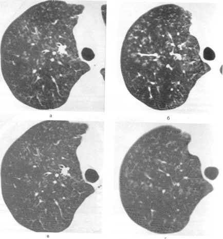 Közösségben szerzett pneumonia, CT