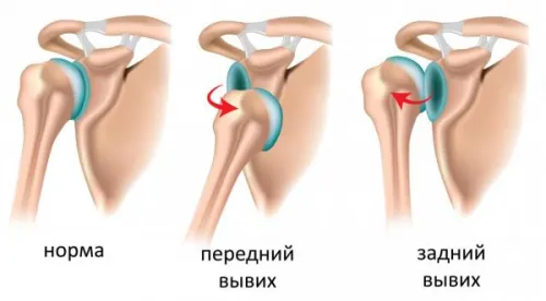 Разместване на раменна става лечение у дома