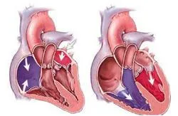 CHF ICD-10