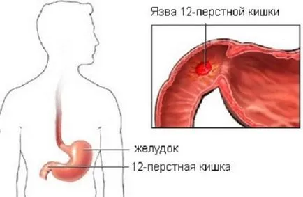 Ulcerul Duodenal - mai periculoase, durata tratamentului, cauzele și consecințele, tipurile de oglindă,