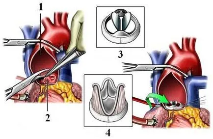 Cseréje és aorta implantációs sebészet - medglobus medglobus