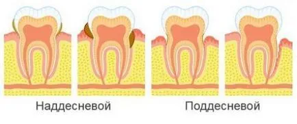 Тартар как да се отървете от отстраняването от ултразвук, видео