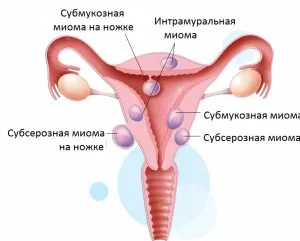 Submucosalis méh mióma - kezelésére népi jogorvoslat daganatok