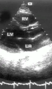 valvă aortică și rădăcinii aortei