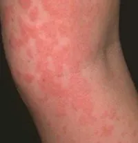 Алергия към морско свинче е там, и какви са симптомите