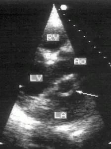 valvă aortică și rădăcinii aortei