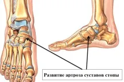 Остеоартритът на симптомите на краката и лечение на народната медицина