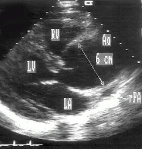 valvă aortică și rădăcinii aortei