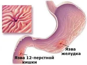 Alcoolul și stomac durerile de stomac după ce a băut efectele alcoolului asupra stomacului!