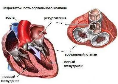 аортна недостатъчност