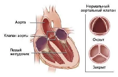 аортна недостатъчност