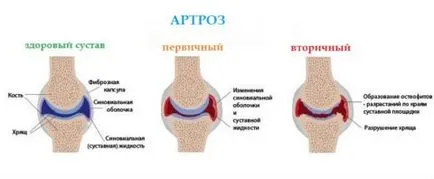 Osteoarthritis a bokaízület tünetek és a kezelés a betegség