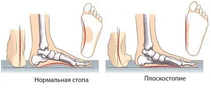 Osteoarthritis a bokaízület tünetek és a kezelés a betegség