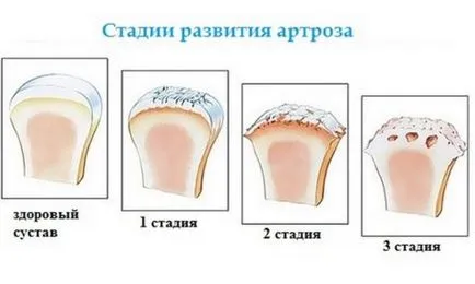 Osteoarthritis a bokaízület tünetek és a kezelés a betegség