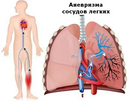 аневризма симптоми