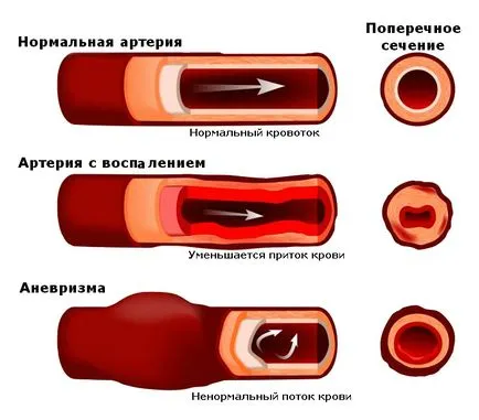 аневризма симптоми