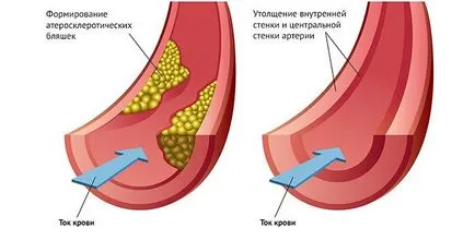 Atherosclerosis az alsó végtagok, a tünetek és a kezelés