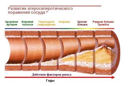 Атеросклерозата на долните крайници, симптомите и лечението