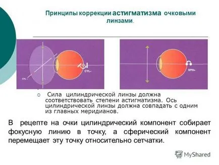 Astigmatismul ICD-10 miop și hipermetroapa, complicat, amestecat,, gradul de simplu