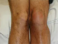Bursita a genunchiului de tratament, simptomele, cauzele și diagnostic