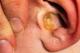 Bullosus otitis megjelentek a betegség tünetei és kezelési módszerek