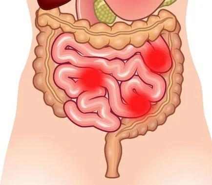 simptome dureri intestinale, cauze si tratament