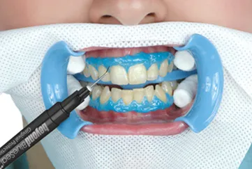 Централна Dental избелване и почистване на зъби в Челябинск