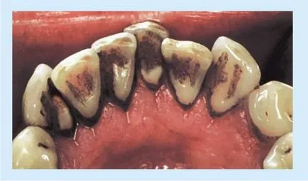 placa negru pe dinti