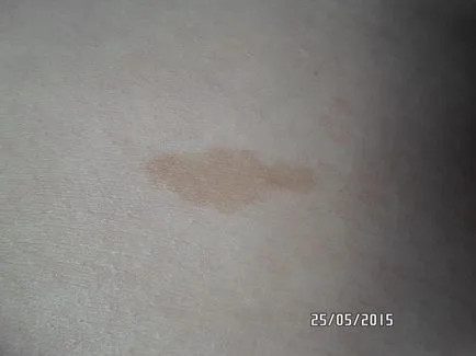 Ceea ce este diferit de semnul din nastere birthmark