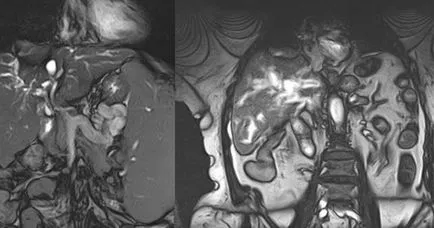 MRI показва, че ретроперитонеален и указания за