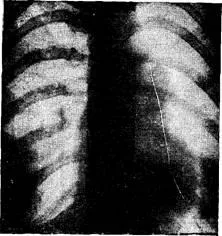 Defect de aorto-pulmonară sept - boli de inima