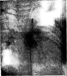 Defect de aorto-pulmonară sept - boli de inima