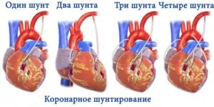 Exerciții de respirație după o intervenție chirurgicală cardiacă