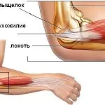 лакът епикондилит лечение на народната медицина