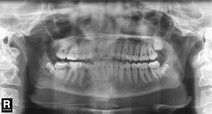 Etapele tratamentului ortodontic - separare stomatologie atribeaute clinicii