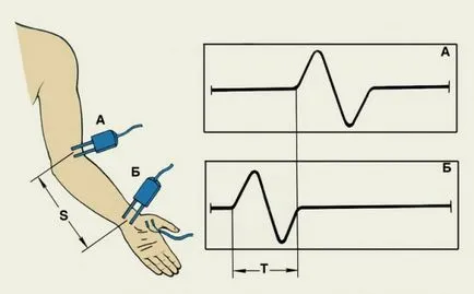 Elektromiográfia olvasmányok, típusai