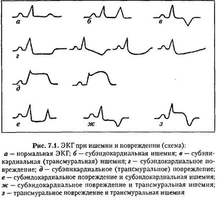 ECG în timpul insuficiență coronariană