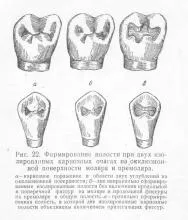 Formarea primei clase de cavități, stomatologie protetice