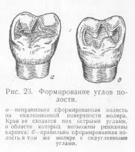 Formarea primei clase de cavități, stomatologie protetice