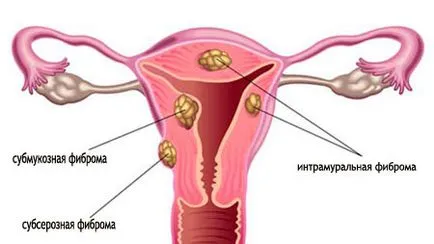 fibrom uterin ce este, simptomele și cauzele