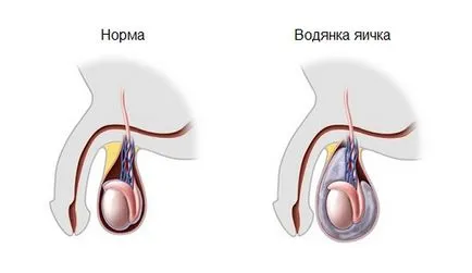 Hemoroizilor și patologii relație prostatita și caracteristicile lor