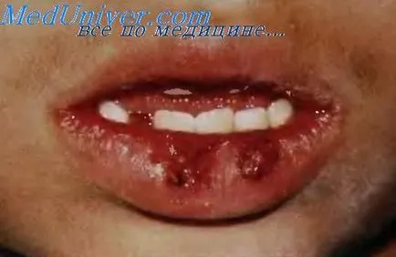 Herpetic gingivostomatite - diagnostic, tratament