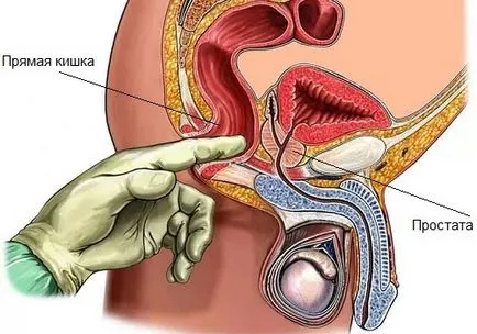 Hemoroizilor și patologii relație prostatita și caracteristicile lor