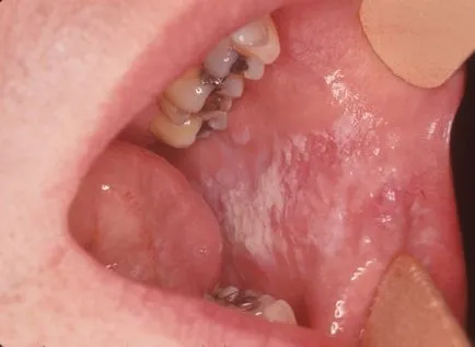 herpeszes gingivostomatitis