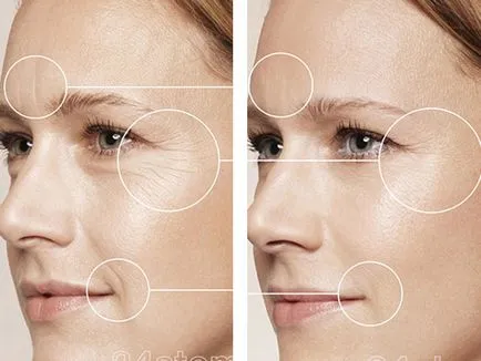 Хиалуроновата киселина за лицето снимка преди и след
