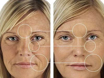 Хиалуроновата киселина за лицето снимка преди и след